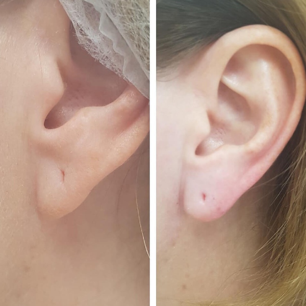 Пластика мочки уха картинка до и после
